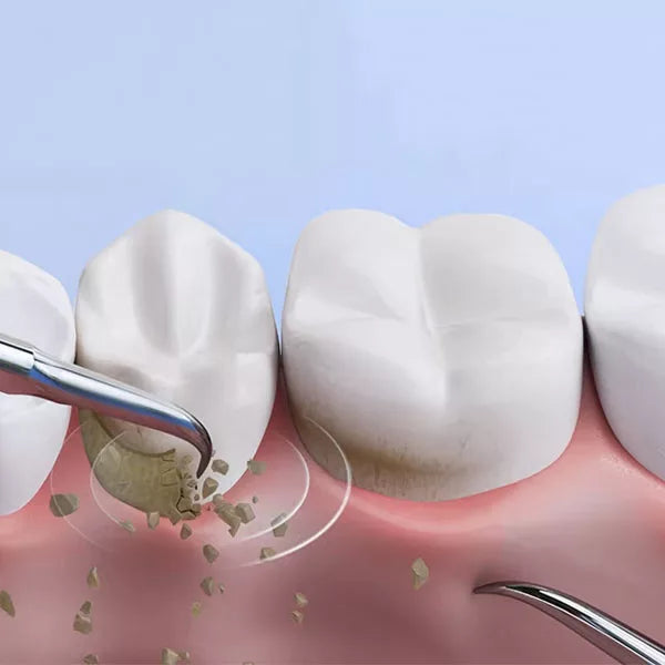 Ultrasonic dental plaque remover with stainless steel heads, designed for precision cleaning and tartar removal at home.