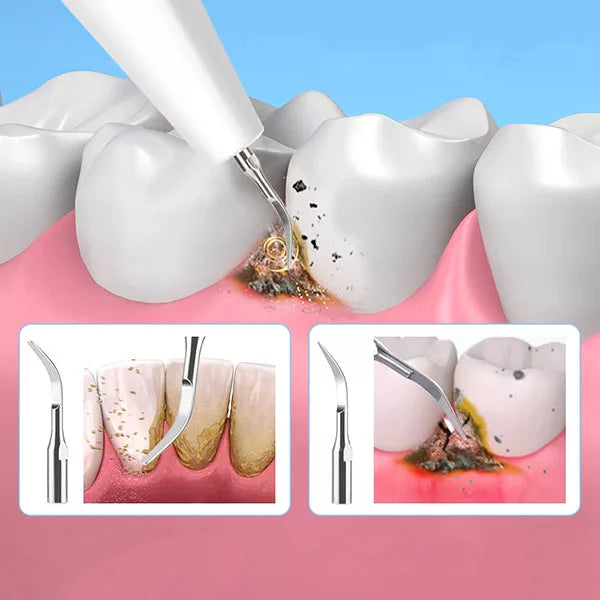 Ultrasonic dental plaque remover with stainless steel heads, designed for precision cleaning and tartar removal at home.